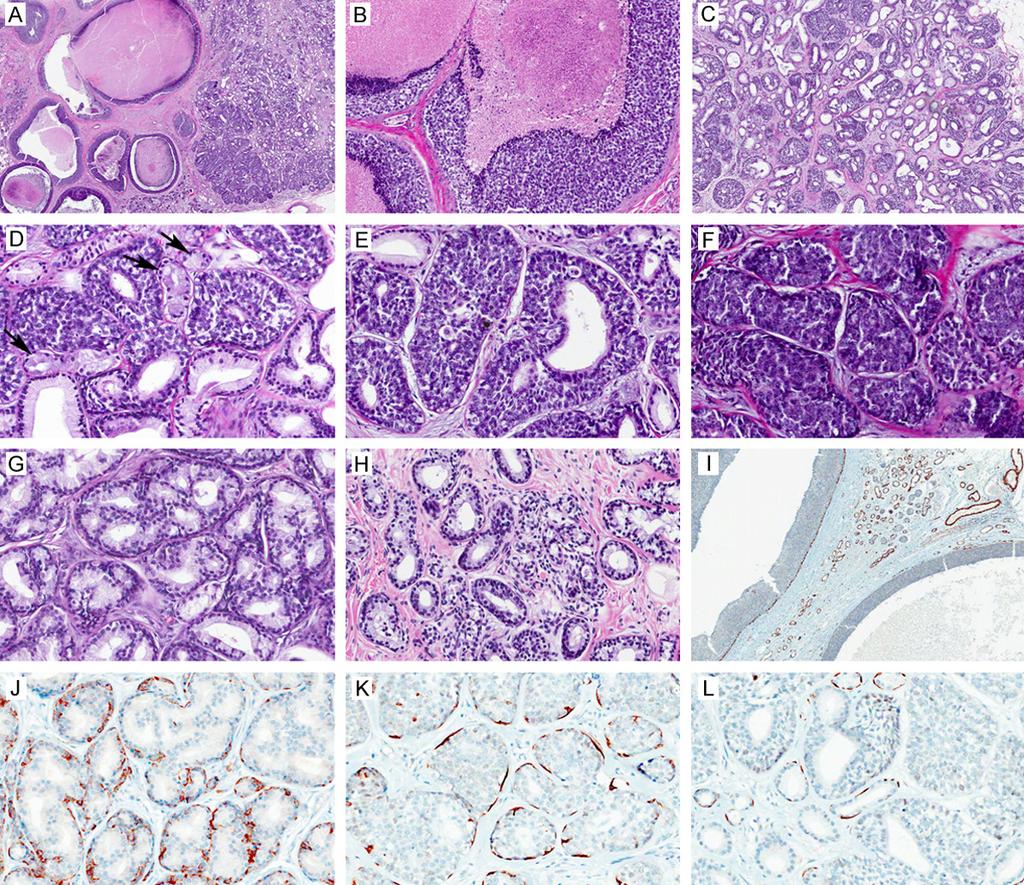 Figure 3. Representative histological findings and immunohistochemical results. A: In low-power field, ductal carcinoma in situ (DCIS) is surrounded by salivary gland metaplasia ( 10, H&E).