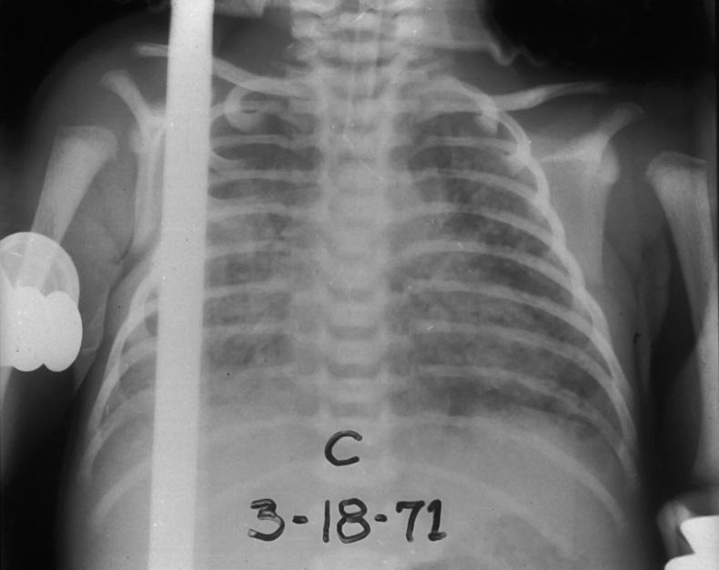 Bronchopulmonary Dysplasia: General Comments: Unresolved neonatal lung injury Most common