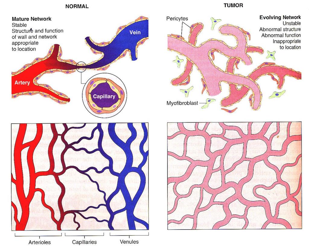 Robbin s Figure 7-41 Tumor angiogenesis. Compared to normal blood vessels (left panels), tumor vessels are tortuous and irregularly shaped.