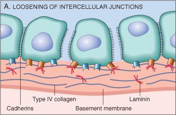 i) Invasion of Extracellular Matrix (ECM) Tumor cells