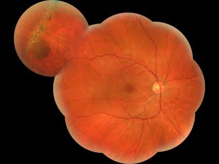 It is important to reassure that no retinal damage is caused by this