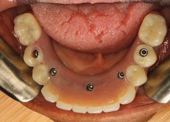 Dental Implant Auxiliaries.