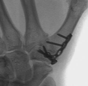 CMC Joint Arthritis Fusion CMC Joint Arthritis Causality/Apportionment CMCJ OA generally genetic/idiopathic Exceptions: Frx/malunion, Male, Laborer Exacerbation & Need for treatment Apportionment