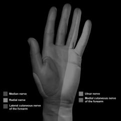Cubital Tunnel Syndrome Ulnar Neuropathy at the Elbow Motor and sensory neuropathy Clinical Features Paresthesias in