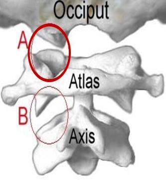 These facets are concave inwards while the occipital condyles are convex.