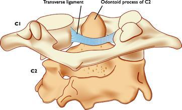 Figure 2.22. Top view of Alar ligament. From Alar Ligament Treatment for CCJ Instability, by Centeno, C., 2015, http://www.regenexx.com/alar-ligament-treatment/. Copyright 2015 by Centeno, C.