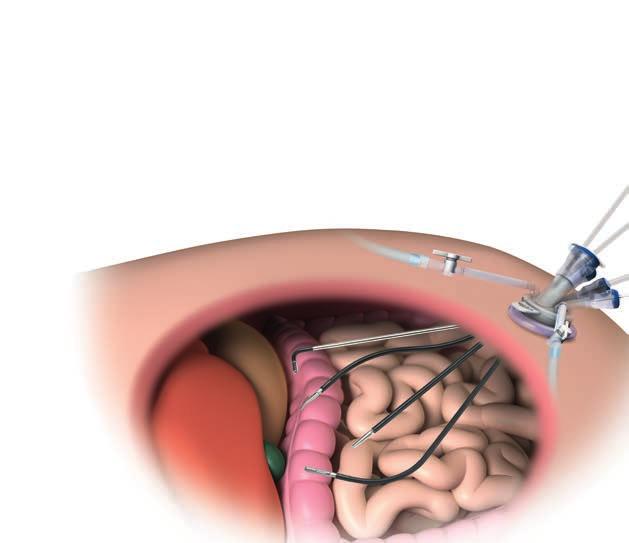 LESS SURGERY A METHOD EVEN LESS INVASIVE THAN CONVENTIONAL LAPAROSCOPY If we compare conventional laparoscopy and LESS surgery, the latter has the advantage that the operation is performed through a