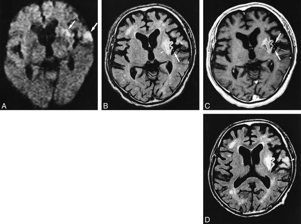 64 MAEDA AJNR:, April 001 FIG 1. Case 10. MR images of 75-year-old man, with right hemiparesis, scanned hours (A C) and days (D) after symptom onset.