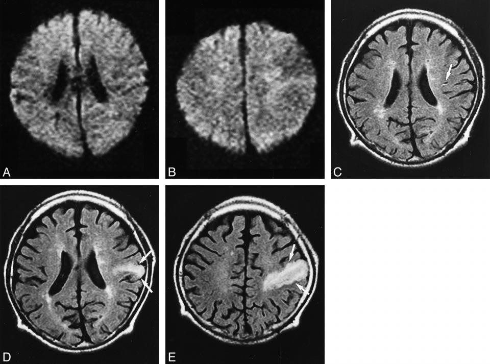 AJNR:, April 001 HYPERACUTE ISCHEMIC STROKE 65 FIG. Case 11. MR images of a 65-yearold man, with right-arm weakness, scanned hours (A C) and days (D and E) after symptom onset.