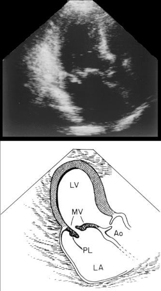 Flail Leaflet = significant MR Tip of the leaflet is in left atrium due to loss