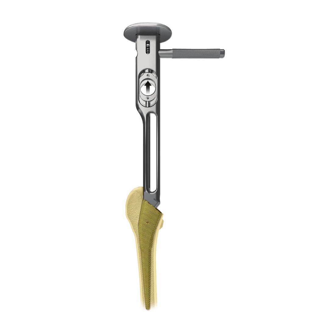 Figure 3 Figure 4 Figure 5 Figure 6 Accessing the Femoral Canal The straight box or offset chisel is used to determine the orientation of the femoral canal and access the lateral section of the