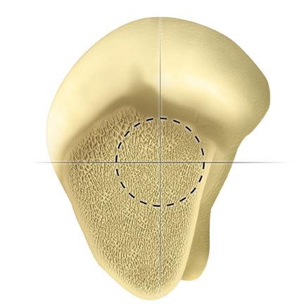The design of the straight box or offset chisel provides for adequate visualisation to allow enough lateralisation of the femoral canal to avoid varus positioning of the component (Figure 3).