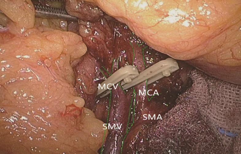 Supplementary Laparoscope-assisted extended right hemicolectomy with D3 lymphadenectomy Extended D3 resection is needed for right colon resection in