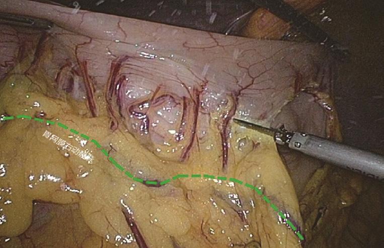of right gastroepiploic artery and vein. When we find the colonic vein along the SMV, the next step is to find the gastrointestinal trunk.