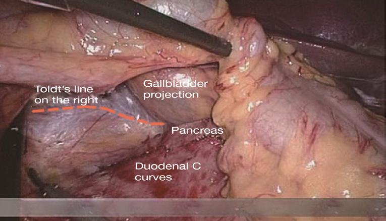 Page 6 of 11 Annals of Laparoscopic and Endoscopic Surgery, 2017 Figure 13 Organs around the right side Toldt s gap. surgeon to perform fine separation.