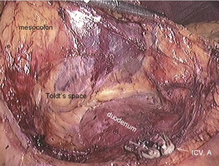 Annals of Laparoscopic and Endoscopic Surgery, 2017 Page 7 of 11 Figure 16 The middle colonic blood vessels.