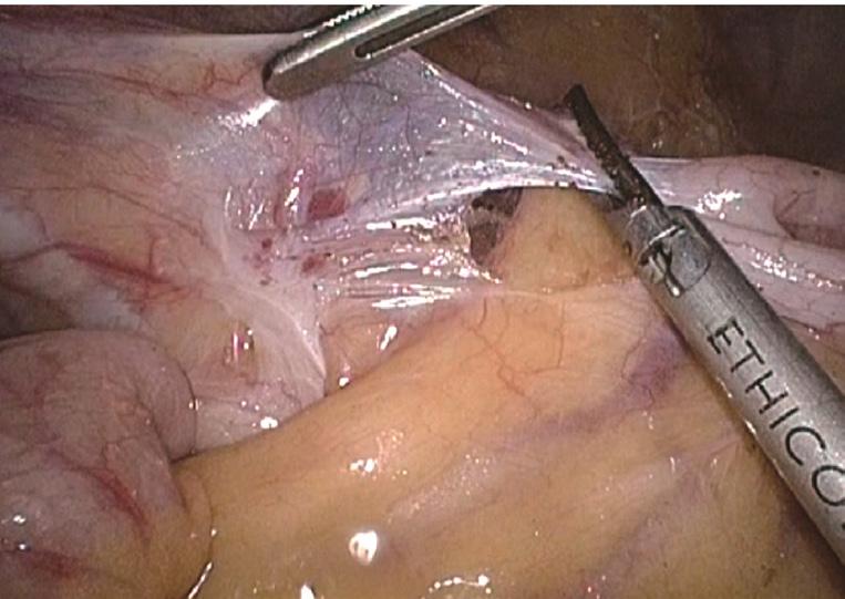 Annals of Laparoscopic and Endoscopic Surgery, 2017 Page 9 of 11 Figure 21 Divide the lateral side of the peritoneum at the ascending ileocecal region.