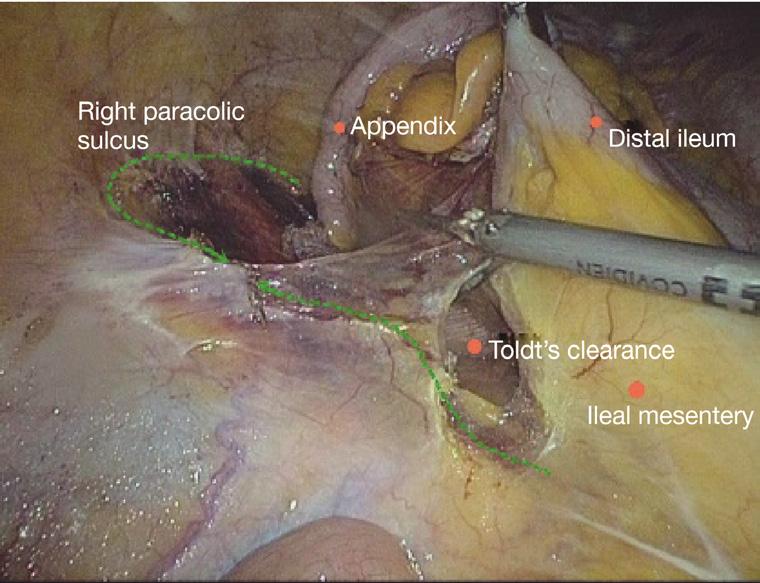 It is recommended to remove the omentum first, which will be more conducive to removing the tumor. Try not to rotate the intestine to avoid reverse during anastomosis.