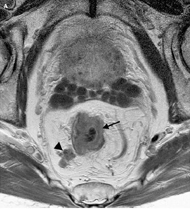 MRI with Surface Coil ADVANTAGES Assess transmural spread See perirectal lymph nodes Detect abdominal metastasis Multiplane capabilities LIMITATIONS Does not depict layers of rectal wall Expensive
