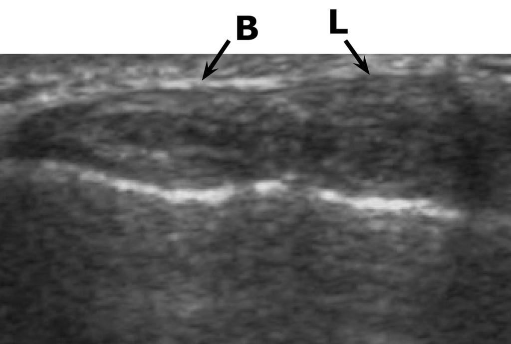First Extensor Compartment of the Wrist Figure 7. Sonogram from a cadaveric specimen. The extensor carpi radialis compartment with the extensor carpi radialis brevis (B) and longus (L) is shown.