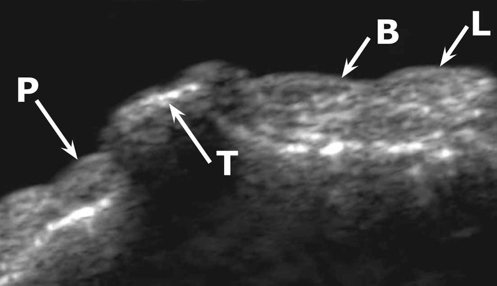 On MRI, the thickening of the tendons may be seen, and the tendons may show an increased signal and be surrounded by a fluid collection in the tenosynovial sheath.
