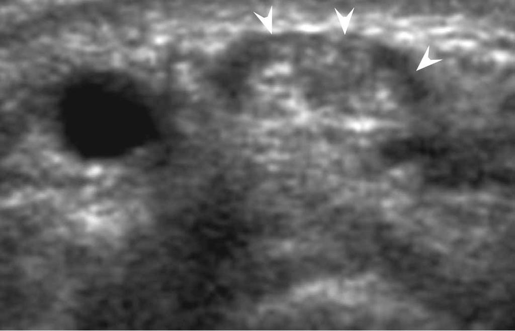 First Extensor Compartment of the Wrist Figure 16. Sonogram from an asymptomatic 37-year-old man. Three separate tendons are shown (arrows).