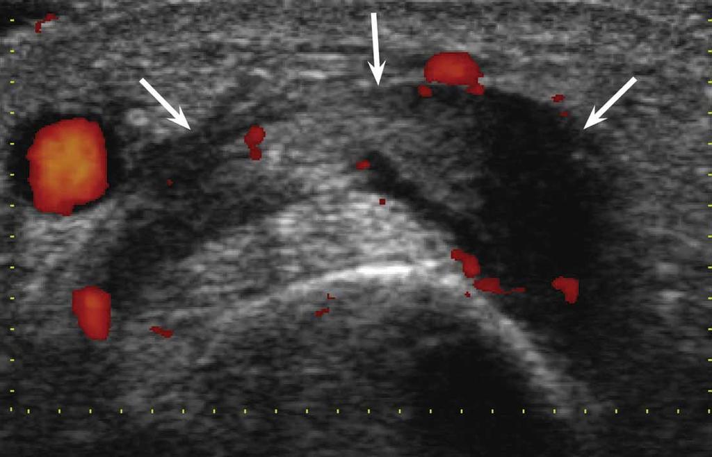 Sonograms from a 43-year-old woman with radial-sided pain. Typical sonographic findings are shown. In Figure 20 (top), tendon thickening (T) and tendon sheath effusion (arrowheads) are shown.