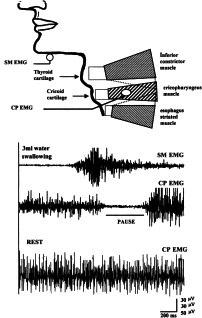 JMD J Mov Disord 2014;7(2):31-56 A B Figure 12. A: Schematic diagram showing electromyogram recording method for cricopharyngeal sphincter (CP-EMG) and submental muscles (SM-EMG).