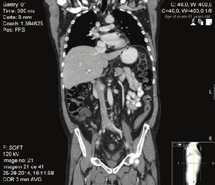 Case Report A 52-year-old man, with a 4-month history of bloody stool, change in size and shape of stools, and feeling of incomplete defecation, is subjected to a colonoscopy that revealed ulcer