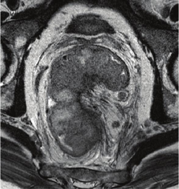 Case Reports in Surgery 3 (a) Axialplan (b) Coronal plan Figure 2: MRI before CRT.