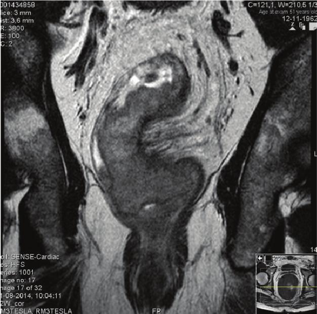 Thin arrow: metastatic lymph node; thick arrow: mesorectal fascia invasion. (a) Axialplan (b) Coronal plan Figure 3: MRI 11 weeks after CRT completion.