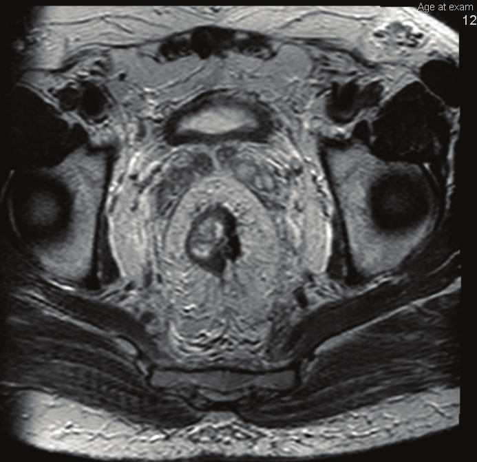 Thin arrow: areas of fibrosis (very low signal intensity); thick arrow: areas of residual tumor (intermediate signal intensity). The ileostomy closure was performed 6 weeks after rectal surgery. 3.