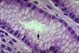 Giemsa stain demonstrating colonization of the gastric mucosa by H. pylori.