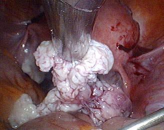 H Hysterectomy April 27th, 2016 Key points in myomectomy Update on strategies for safe and