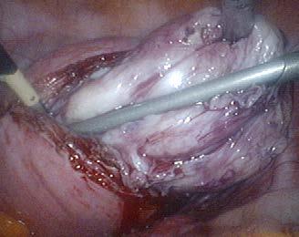 Gracia Uterine suture after myomectomy Laparoscopic myomectomy Dra. M. A.