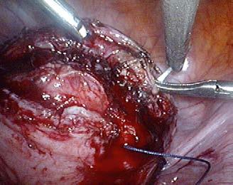 suturing and knotting, hysterectomy, adnexectomy, dissection of the retroperitoneal space,