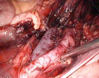 lymphadenectomy will be (Maximum two students per animal) Dissection of the retroperitoneal