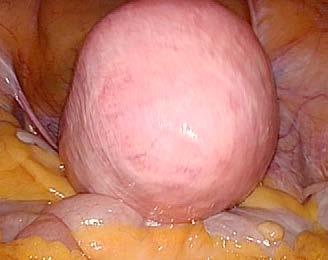 M Myomectomy June 8th, 2016 Key points in hysterectomy Dra. M. A.
