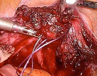animal) Laparoscopic suturing and knotting, hysterectomy, adnexectomy, dissection of the
