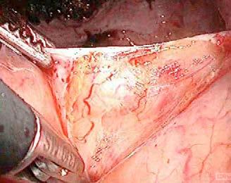 PF Pelvic Floor June 29th, 2016 Abdominal/ surgery versus vaginal surgery In the repair of pelvic
