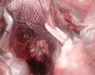 space, dissection, nephrectomy, injury repair and vascular injury repair, Dra. M. A.