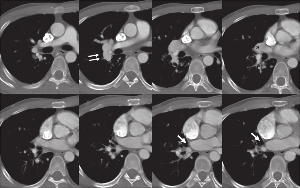 Serial axial images show low-attenuation linear structure (arrows) between right inferior pulmonary vein and left atrium, as well as prominent right