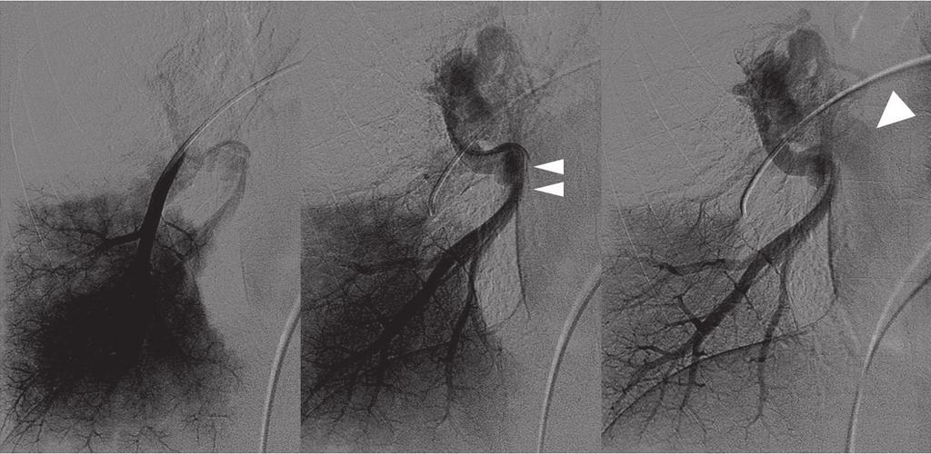 Lee et al. D E Fig. 1. Lobar pulmonary vein atresia of right lower lobe in 32-year-old man. D. Reformatted coronal image shows tortuous and dot-like collaterals (black arrowheads) in superior segment of right lower lobe.