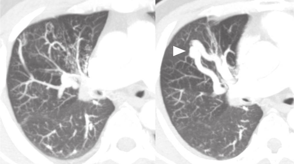 Individual Pulmonary Vein Atresia in Adults A B C Fig. 2. Segmental pulmonary vein atresia of apical segment from right upper lobe in 43-year-old man. A. Slap axial images with lung setting show tortuous and dot-like collaterals in anterior segment of right upper lobe.