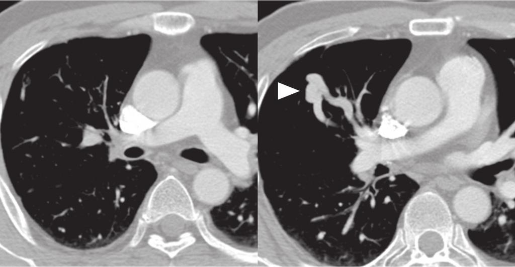 This finding is consistent with imaging findings of pulmonary arteriovenous malformation, but we diagnosed it as collateral, from apical segment to anterior segment of right upper lobe on pulmonary