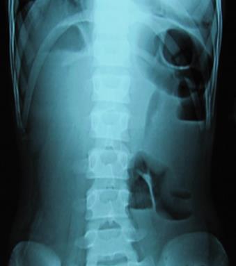 age of 12 years with features of faecopneumothorax, intestinal obstruction and septicaemia. Intraoperatively pt.