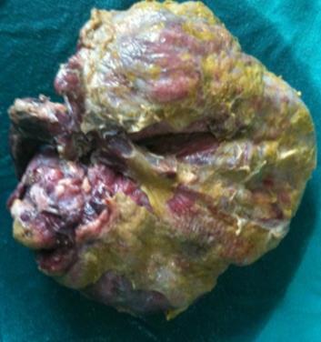 Perforated right colon