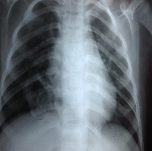 Figure 8: Chest X-ray of