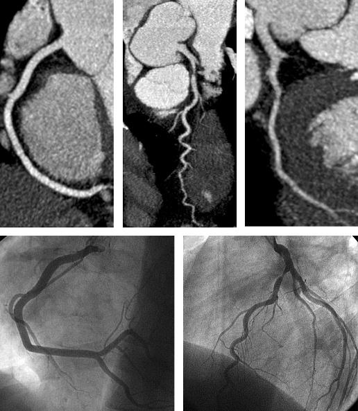No plaques or stenoses were present in CT. Similarly, conventional coronary angiography of the left (D) and right (E) coronary artery demonstrates no CAD. one patient having an Agatston score of 455.
