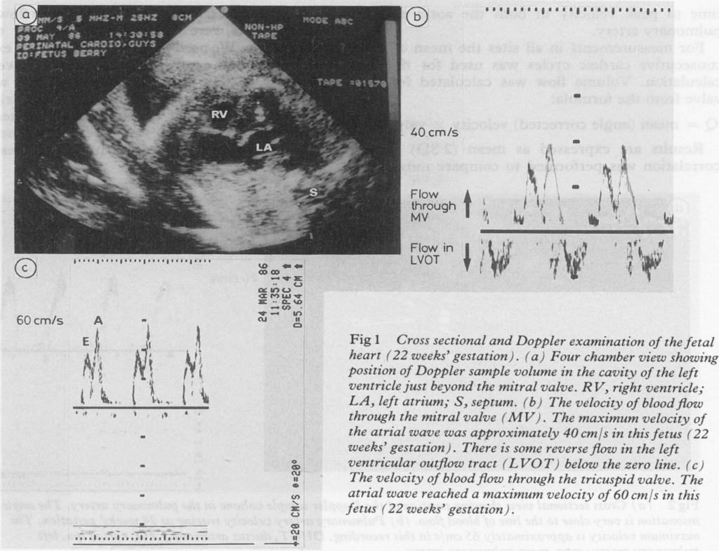 Doppler echocardiographic evaluation of the normal human fetal heart a..: 6 cm/s -S.,- 4 a <C tols&s,.... h.. I'.9. a..l... t Zlw S. i~~~~~~~~~~~n.